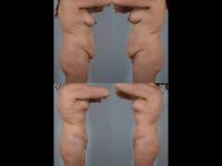 before and after tummy tuck female patient left and right side view case 5534