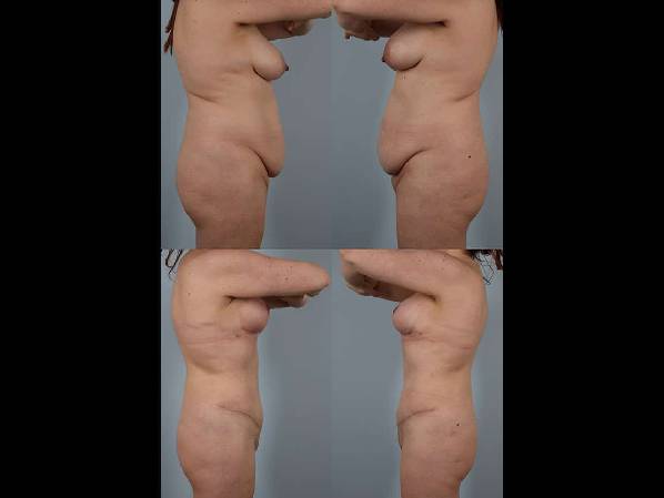 before and after tummy tuck female patient left and right side view case 5534