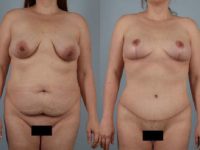 before and after tummy tuck female patient front view case 5534