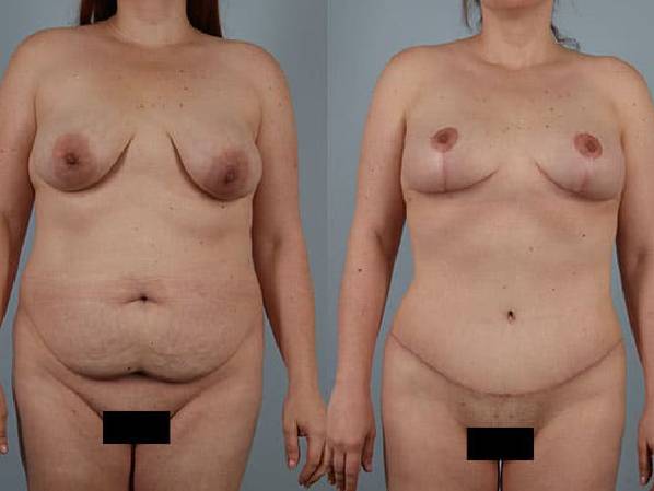 before and after tummy tuck female patient front view case 5534