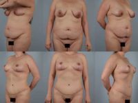 before and after tummy tuck female patient multiple angle view case 5534