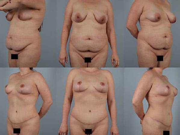 before and after tummy tuck female patient multiple angle view case 5534
