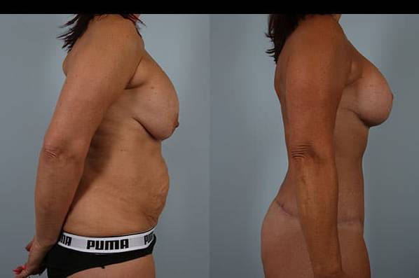 before and after tummy tuck female patient right side view case 5616