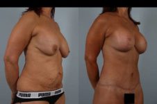 before and after tummy tuck female patient right diagonal view case 5616