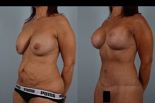 before and after tummy tuck female patient left diagonal view case 5616