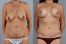 before and after tummy tuck female patient front view case 5639