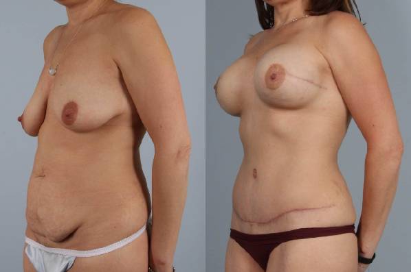 before and after tummy tuck female patient left diagonal view case 5639