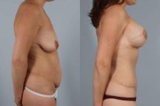 before and after tummy tuck female patient right side view case 5639