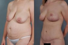 before and after tummy tuck female patient left diagonal view case 5654