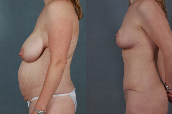 before and after tummy tuck female patient left side view case 5654