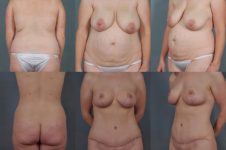 before and after tummy tuck female patient multiple angle view case 5654