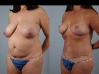 before and after tummy tuck female patient left diagonal view case 5666