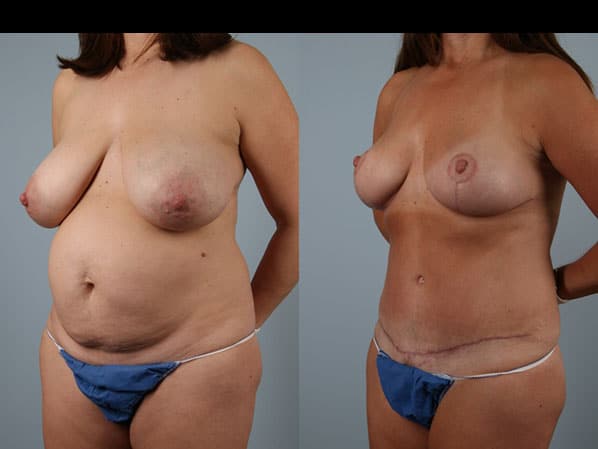 before and after tummy tuck female patient left diagonal view case 5666