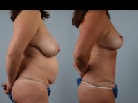 before and after tummy tuck female patient right side view case 5666