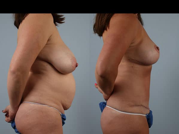 before and after tummy tuck female patient right side view case 5666