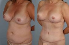 before and after tummy tuck female patient left diagonal view case 5693