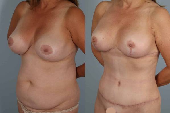 before and after tummy tuck female patient left diagonal view case 5693