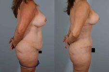before and after tummy tuck female patient right side view case 5693
