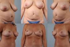 before and after abdominoplasty female patient multiple angles view case 5666