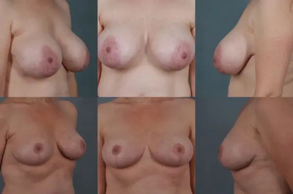 before and after breast reduction female patient multiple angle view case 4865