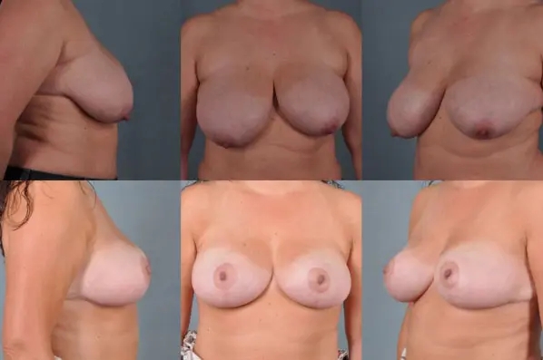 before and after breast reduction female patient multiple angle view case 4943