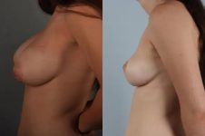 before and after breast reduction female patient left side view case 5019