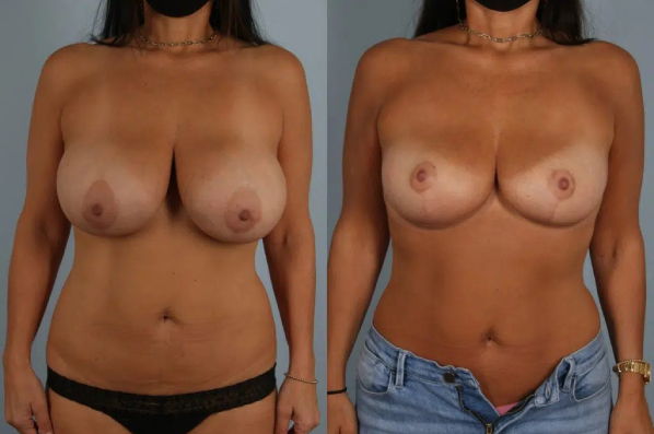 before and after breast reduction female patient front view case 5189