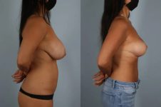 before and after breast reduction female patient right side view case 5189