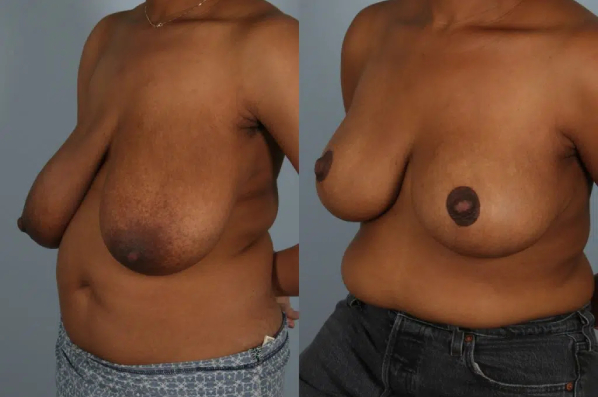 before and after breast reduction female patient left diagonal front view case 5162