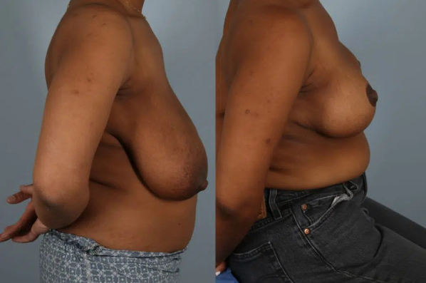 before and after breast reduction female patient right side view case 5162