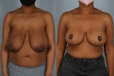 before and after breast reduction female patient front view case 5162