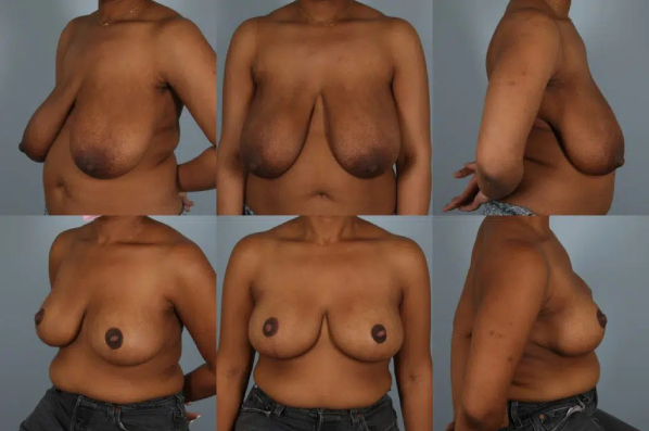 before and after breast reduction female patient multiple angle view case 5162
