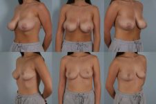 before and after breast reduction female patient multiple angle views case 5035
