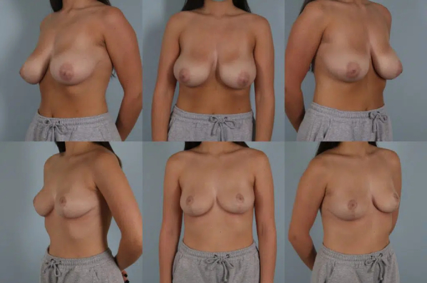 before and after breast reduction female patient multiple angle views case 5035