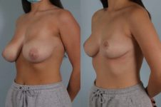 before and after breast reduction female patient left diagonal front view case 5035