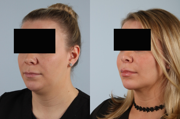 before and after facelift SMAS composite (deep plane) female patient left diagonal view case 5378