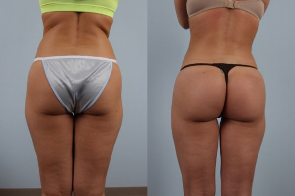 before and after liposuction female patient back view case 4824