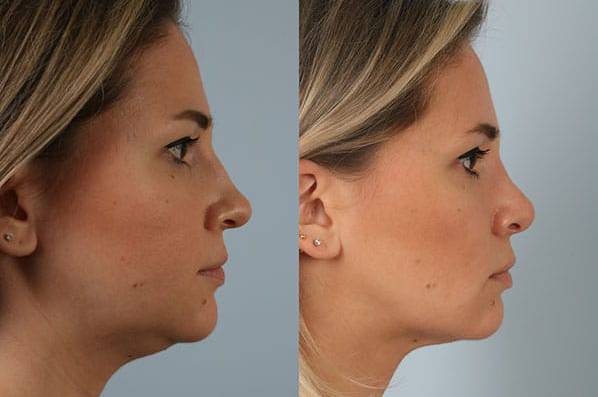 before and after liposuction female patient right side view case 4833