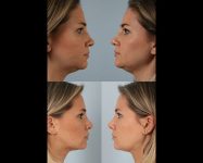before and after liposuction female patient right and left side view case 4833
